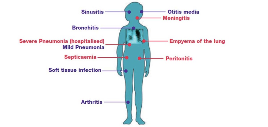 Pneumococcal Immunisation | Glebe Hill Family Practice