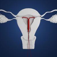 Glebe Hill Family Practice - IUD's